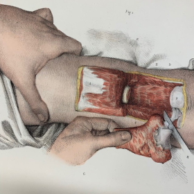 Planche de médecine opératoire: "L'Anatomie de L'Homme" par le Dr Bourgery et le dessinateur Jacob - 1837/1843 - Lithographie