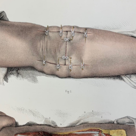 Planche de médecine opératoire: "L'Anatomie de L'Homme" par le Dr Bourgery et le dessinateur Jacob - 1837/1843 - Lithographie