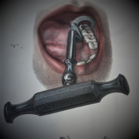 Clef de Garengeot- Clef dentaire - CHARRIERE - XIXème siècle