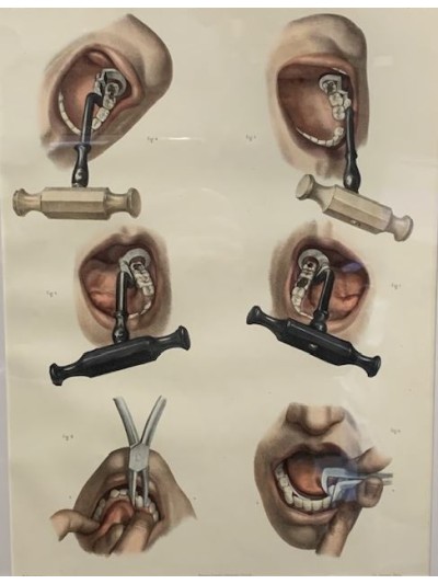 Davier dentaire - Pince pour arracher les dents - 1900 - Luer à Paris