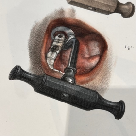 Dental key - Garengeot key - ROISSARD - 19th century